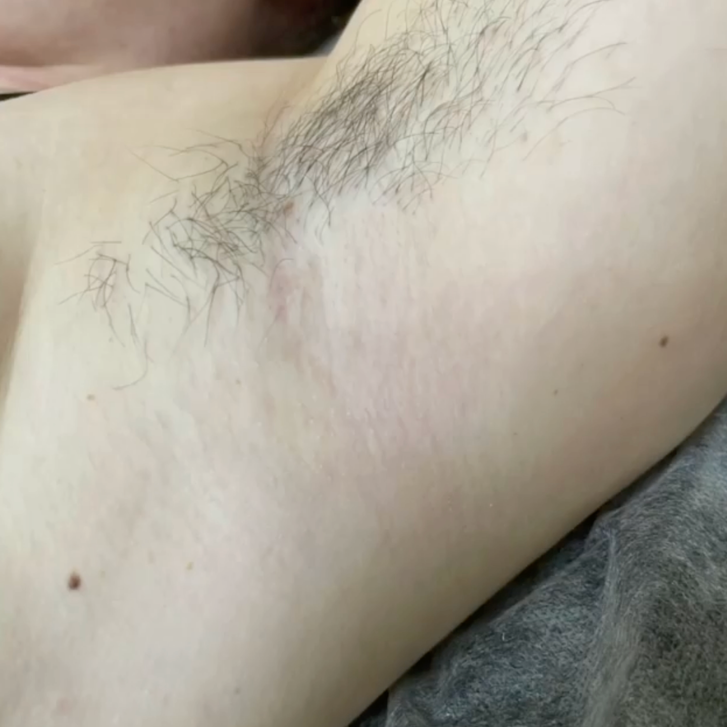 before after sugaring underarms